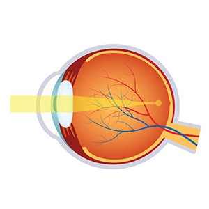 Diagram of Eyeball with Myopia